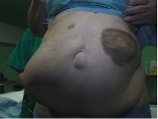 Mujer obesa con tres cirugías previas y una eventración iliaca gigante + eventración supraumbilical.